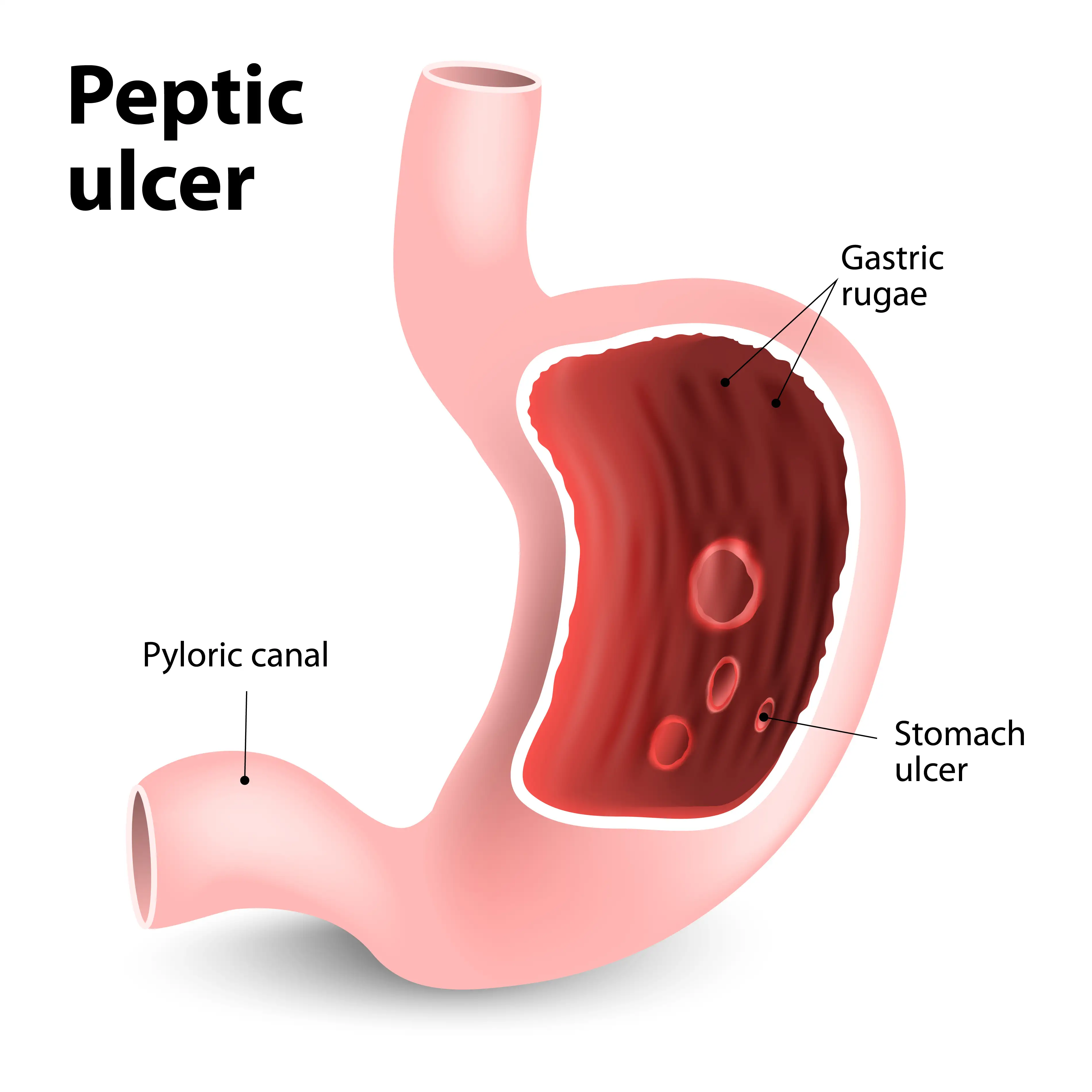 Peptic.ulcer