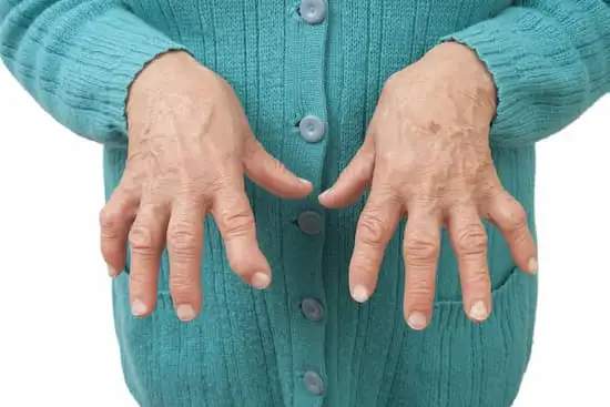 Rheumatoid.Arthritis