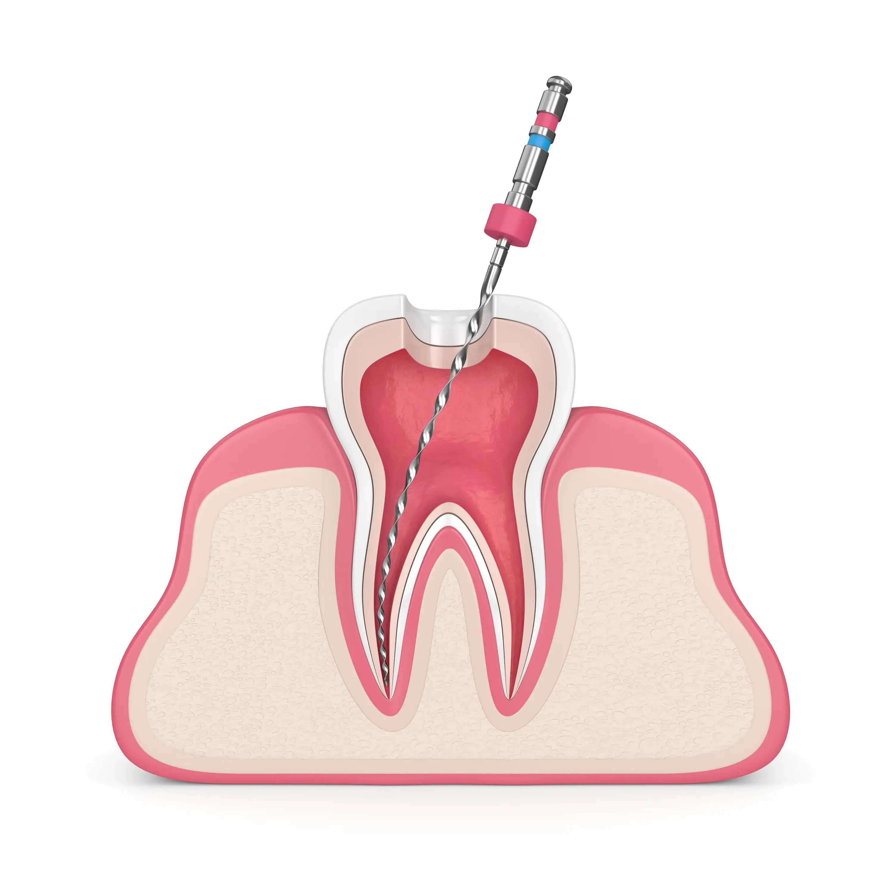 root_canal_surgery
