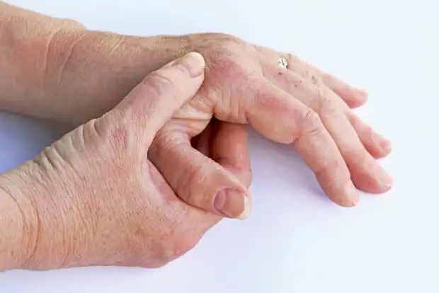 Thumb Basal Joint Arthritis
