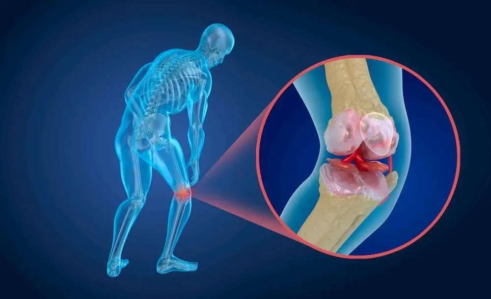 Evaluation of knee osteoarthritis via imaging