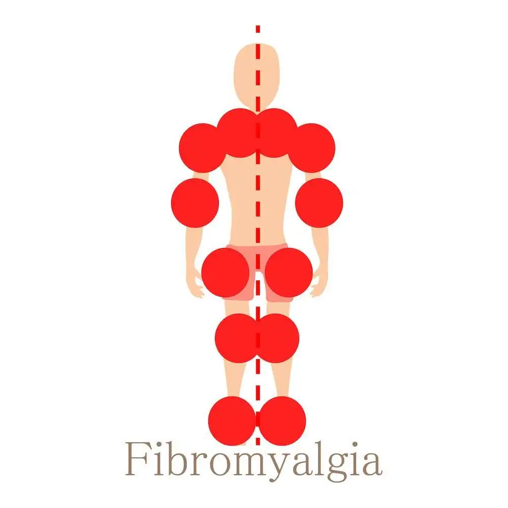 Фибромиалгия может вызывать изменения минеральной плотности костной ткани