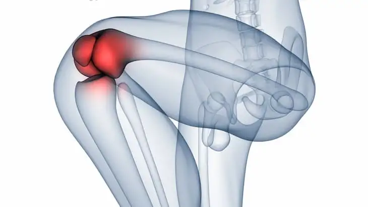 остеоартроз коленного сустава