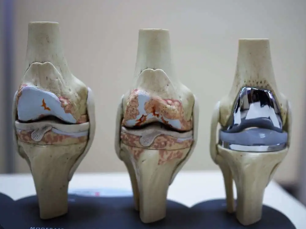 Валидность и чувствительность Шкалы оценки исходов повреждений и остеоартроза коленного сустава (KOOS) у пациентов после тотального эндопротезирования коленного сустава