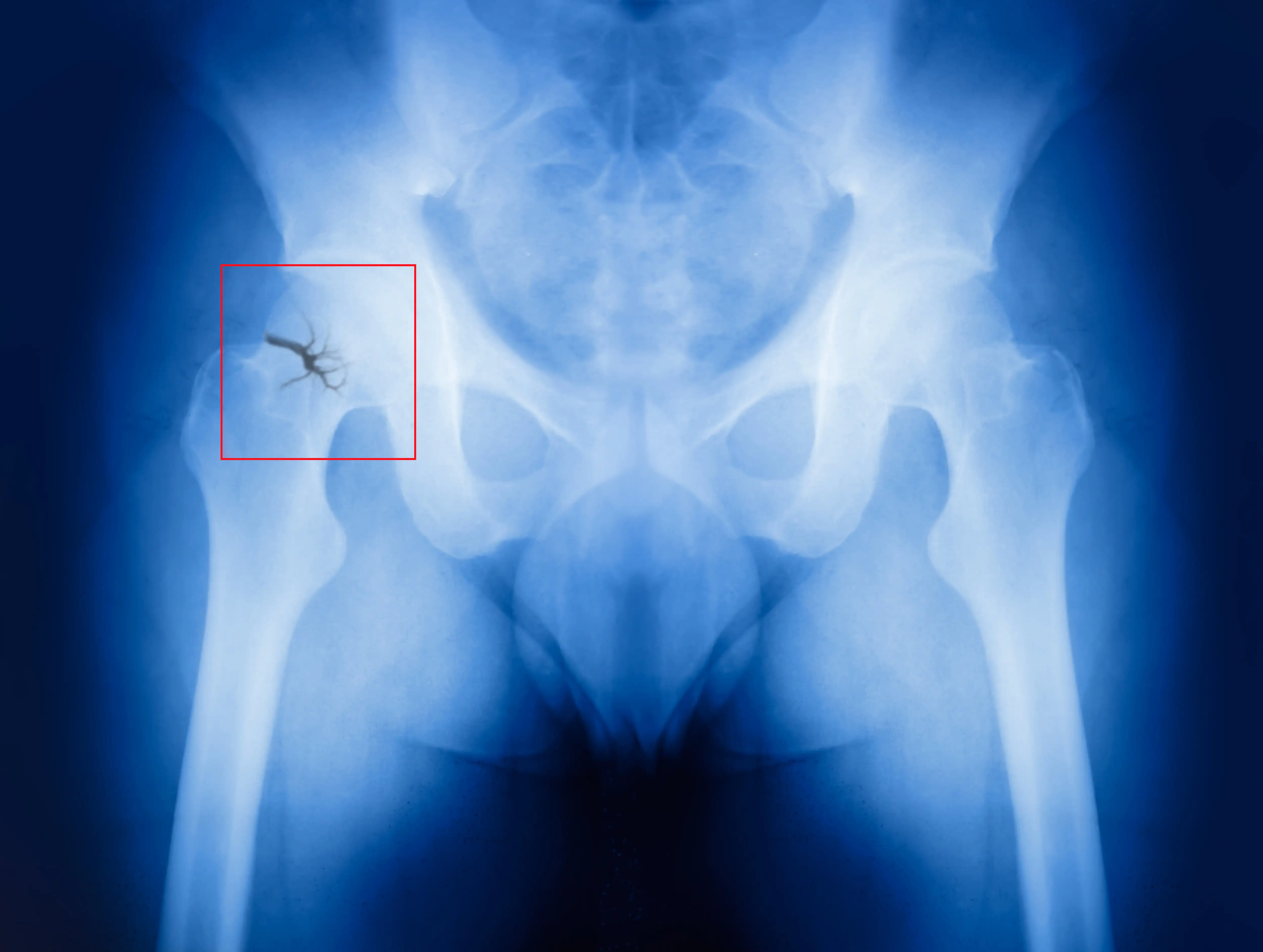 Pelvic fracture