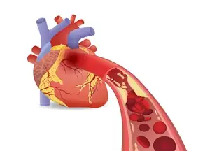 Cardiovascular diseases