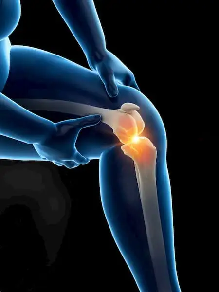 Knee Osteoarthritis