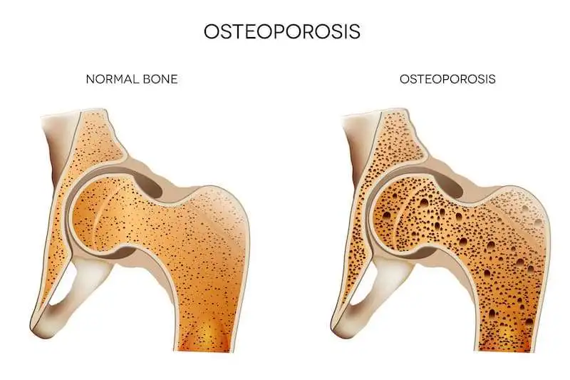 Ингибирование склеростина: новый подход к лечению остеопороза