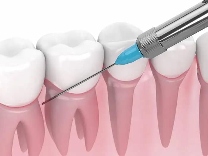 Periodontitis, Pulpitis